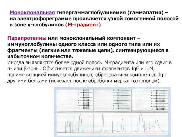 Моноклональная гипергаммаглобулинемия (гаммапатия) – на электрофореграмме проявляется узкой гомогенной полосой в