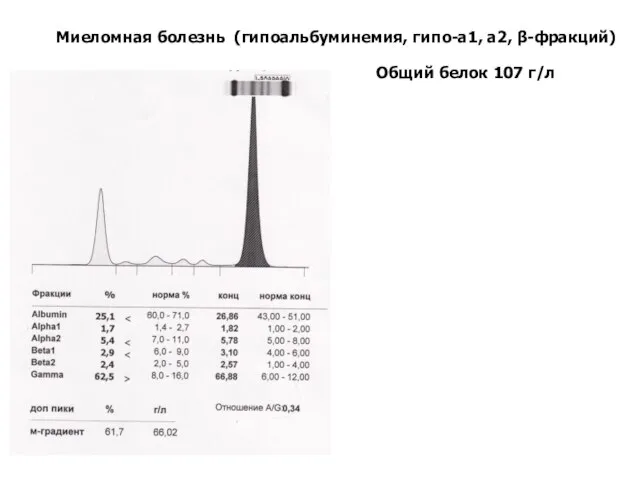 Общий белок 107 г/л Миеломная болезнь (гипоальбуминемия, гипо-а1, а2, β-фракций)