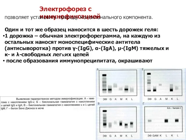 Электрофорез с иммунофиксацией позволяет установить природу моноклонального компонента. Один и тот