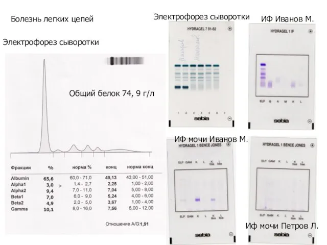 Болезнь легких цепей Электрофорез сыворотки Общий белок 74, 9 г/л Электрофорез