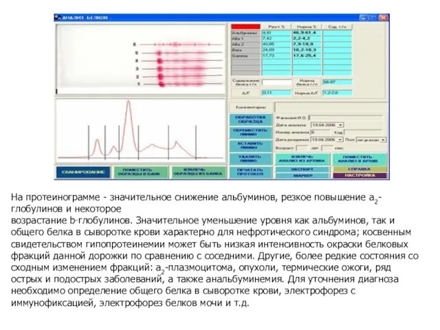 На протеинограмме - значительное снижение альбуминов, резкое повышение a2-глобулинов и некоторое