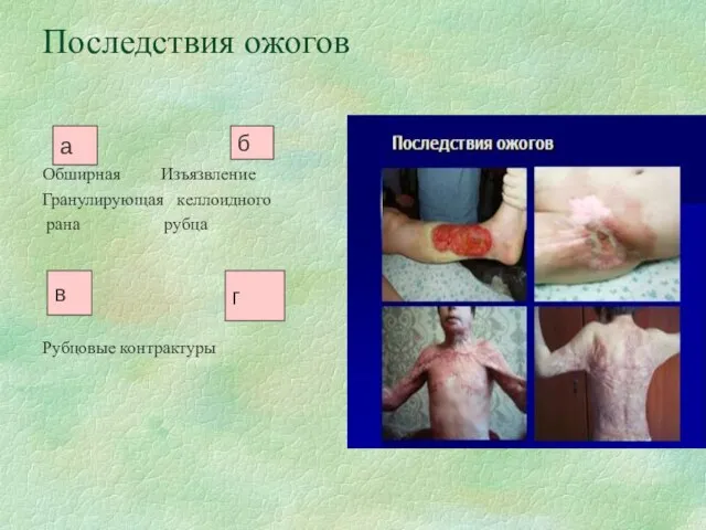 Последствия ожогов Обширная Изъязвление Гранулирующая келлоидного рана рубца Рубцовые контрактуры а б в г