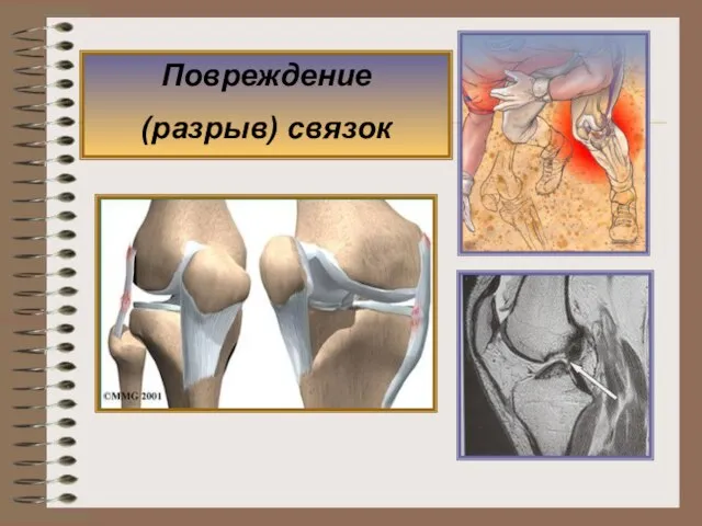 Повреждение (разрыв) связок