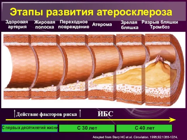 Этапы развития атеросклероза Здоровая артерия Жировая полоска Переходное повреждение Атерома Зрелая