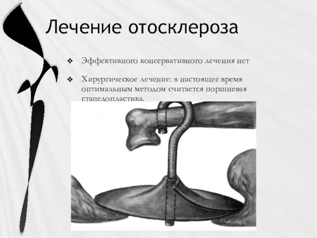 Лечение отосклероза Эффективного консервативного лечения нет Хирургическое лечение: в настоящее время оптимальным методом считается поршневая стапедопластика.