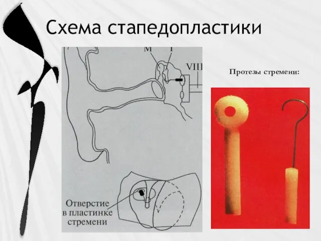 Схема стапедопластики Протезы стремени: