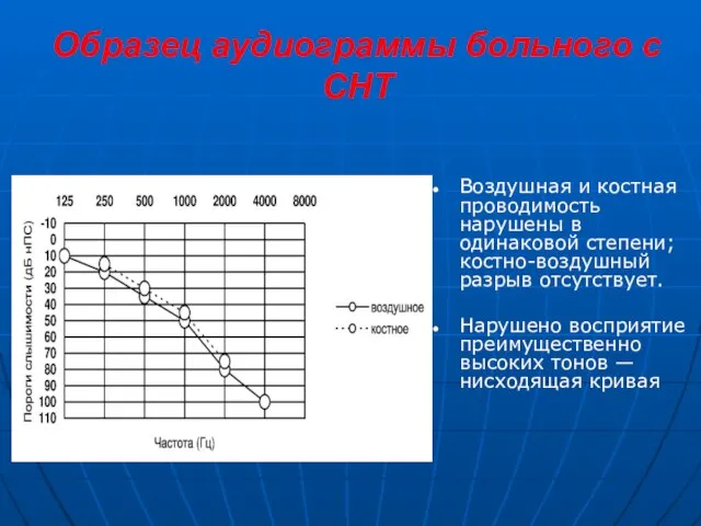 Образец аудиограммы больного с СНТ Воздушная и костная проводимость нарушены в