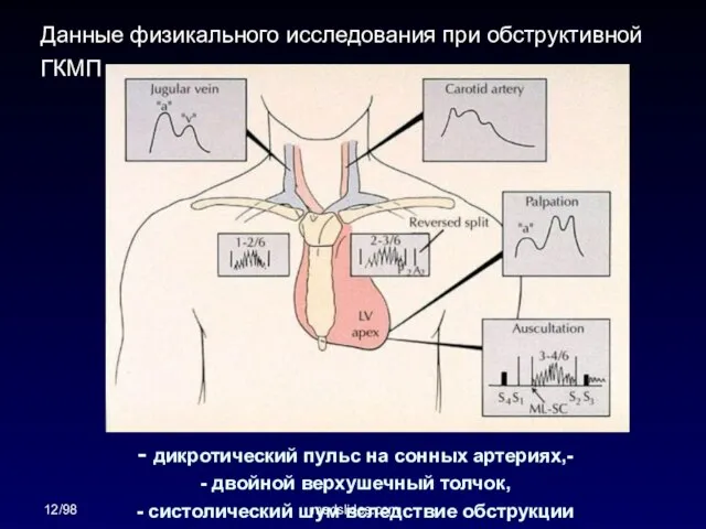 12/98 medslides.com - дикротический пульс на сонных артериях,- - двойной верхушечный