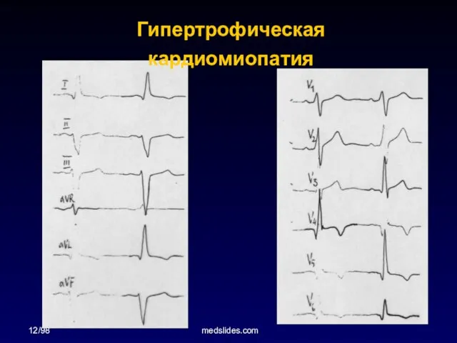 12/98 medslides.com Гипертрофическая кардиомиопатия