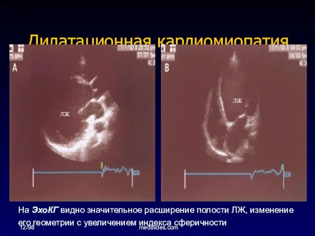 12/98 medslides.com Дилатационная кардиомиопатия ЛЖ ЛЖ На ЭхоКГ видно значительное расширение