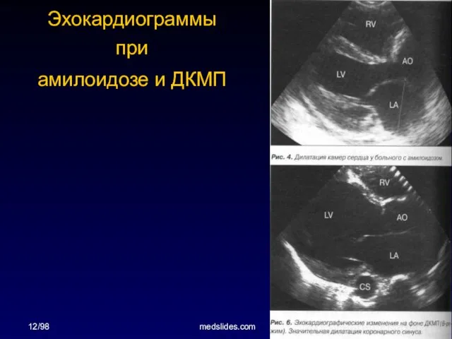 12/98 medslides.com Эхокардиограммы при амилоидозе и ДКМП