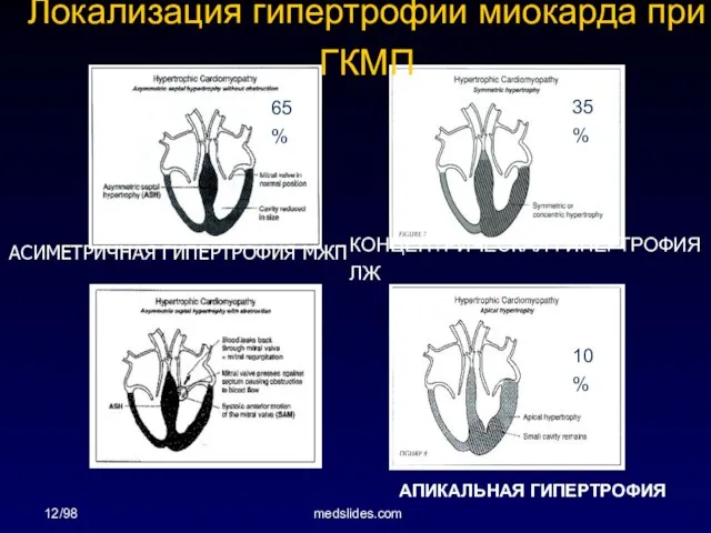 12/98 medslides.com 65% 35% 10% Локализация гипертрофии миокарда при ГКМП АСИМЕТРИЧНАЯ