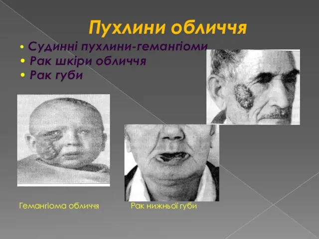 Пухлини обличчя • Судинні пухлини-гемангіоми • Рак шкіри обличчя • Рак