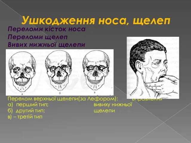 Ушкодження носа, щелеп Переломи кісток носа Переломи щелеп Вивих нижньої щелепи