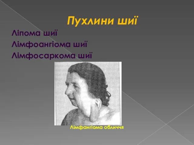 Пухлини шиї Ліпома шиї Лімфоангіома шиї Лімфосаркома шиї Лімфангіома обличчя