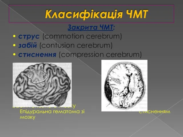 Класифікація ЧМТ Закрита ЧМТ: • струс (commotion cerebrum) • забій (contusion