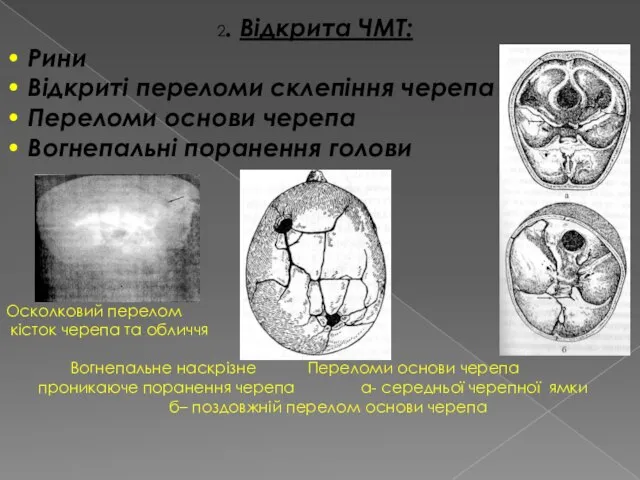 2. Відкрита ЧМТ: • Рини • Відкриті переломи склепіння черепа •