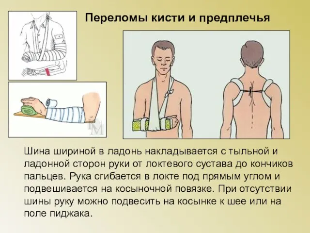 Переломы кисти и предплечья Шина шириной в ладонь накладывается с тыльной