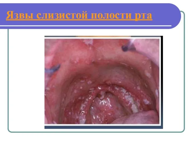 Язвы слизистой полости рта