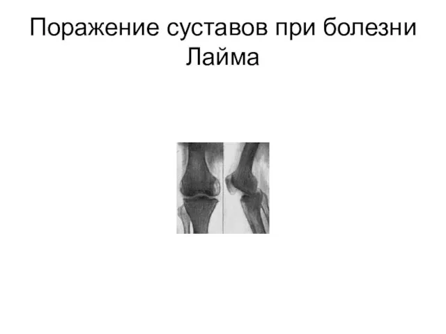 Поражение суставов при болезни Лайма