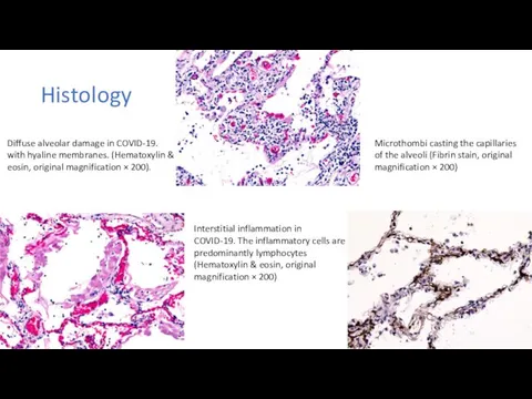 Histology Microthombi casting the capillaries of the alveoli (Fibrin stain, original