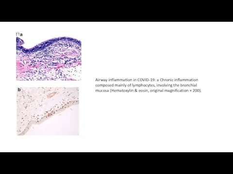 Airway inflammation in COVID-19: a Chronic inflammation composed mainly of lymphocytes,