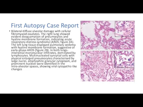 First Autopsy Case Report Bilateral diffuse alveolar damage with cellular fibromyxoid