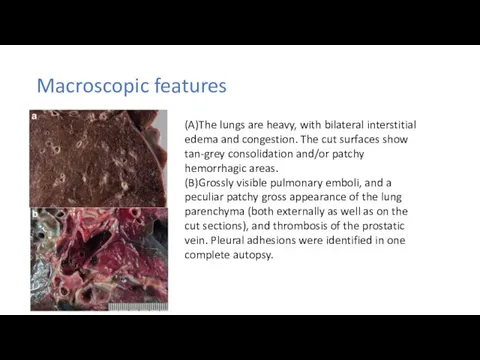 Macroscopic features (A)The lungs are heavy, with bilateral interstitial edema and