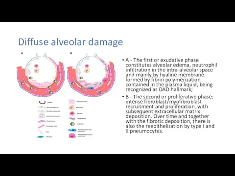 Diffuse alveolar damage A - The first or exudative phase constitutes
