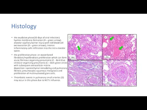 Histology the exudative phase(10 days of viral infection): hyaline membrane formation