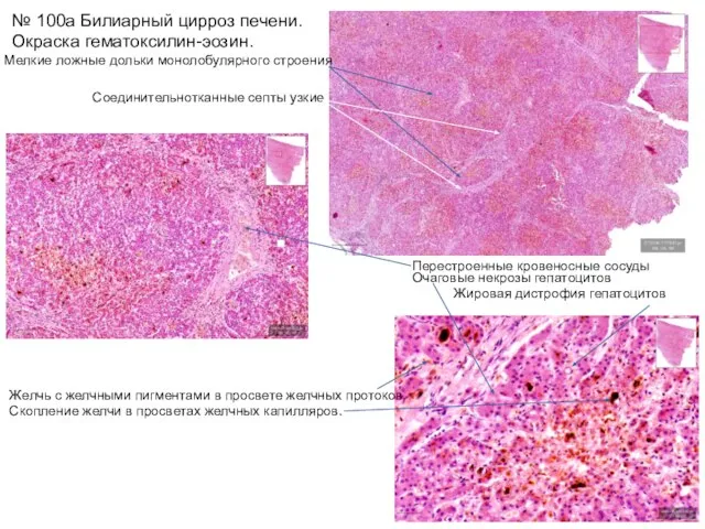№ 100а Билиарный цирроз печени. Окраска гематоксилин-эозин. Мелкие ложные дольки монолобулярного