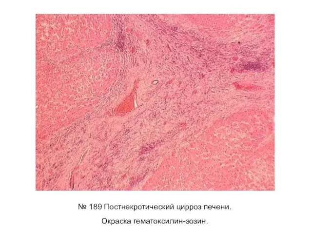№ 189 Постнекротический цирроз печени. Окраска гематоксилин-эозин.