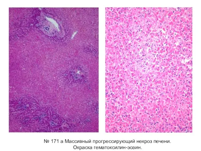 № 171 а Массивный прогрессирующий некроз печени. Окраска гематоксилин-эозин.