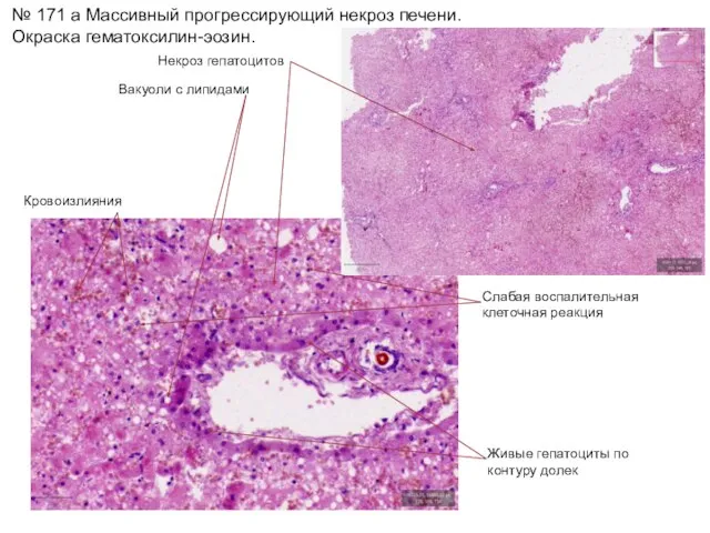 № 171 а Массивный прогрессирующий некроз печени. Окраска гематоксилин-эозин. Некроз гепатоцитов