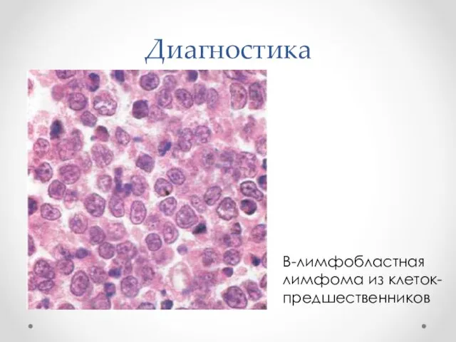 Диагностика В-лимфобластная лимфома из клеток-предшественников