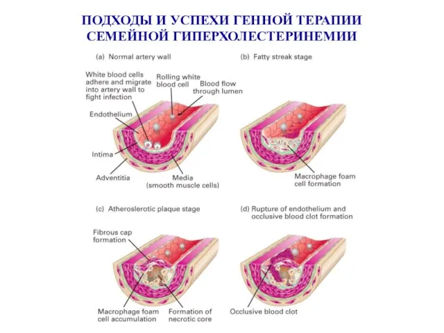 ПОДХОДЫ И УСПЕХИ ГЕННОЙ ТЕРАПИИ СЕМЕЙНОЙ ГИПЕРХОЛЕСТЕРИНЕМИИ