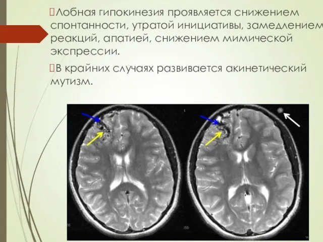 Лобная гипокинезия проявляется снижением спонтанности, утратой инициативы, замедлением реакций, апатией, снижением