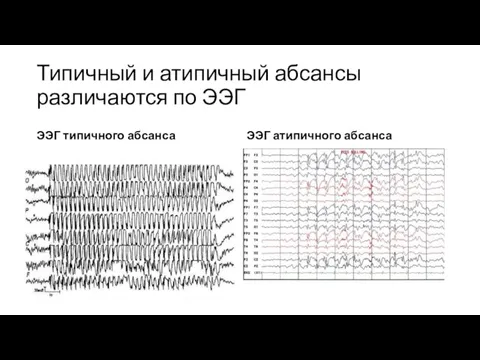 Типичный и атипичный абсансы различаются по ЭЭГ ЭЭГ типичного абсанса ЭЭГ атипичного абсанса