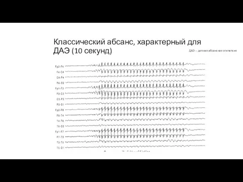 Классический абсанс, характерный для ДАЭ (10 секунд) ДАЭ – детская абсансная эпилепсия