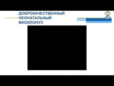 ДОБРОКАЧЕСТВЕННЫЙ НЕОНАТАЛЬНЫЙ МИОКЛОНУС