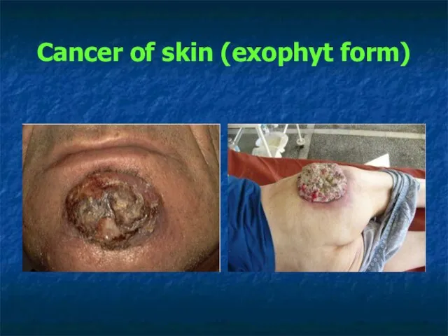 Cancer of skin (exophyt form)