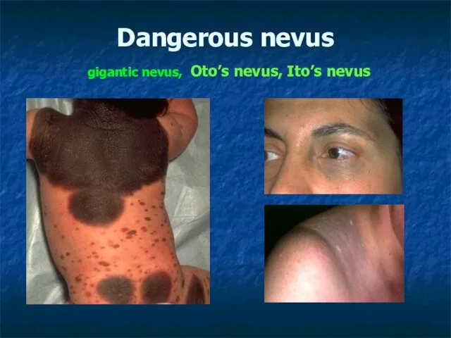 Dangerous nevus gigantic nevus, Oto’s nevus, Ito’s nevus