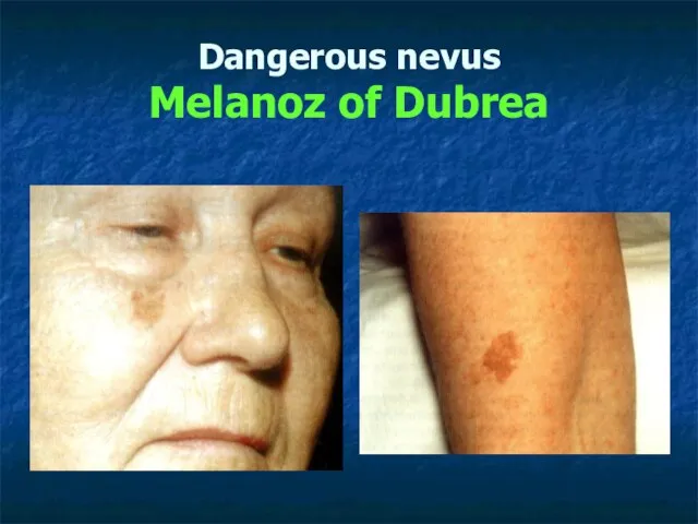 Dangerous nevus Melanoz of Dubrea