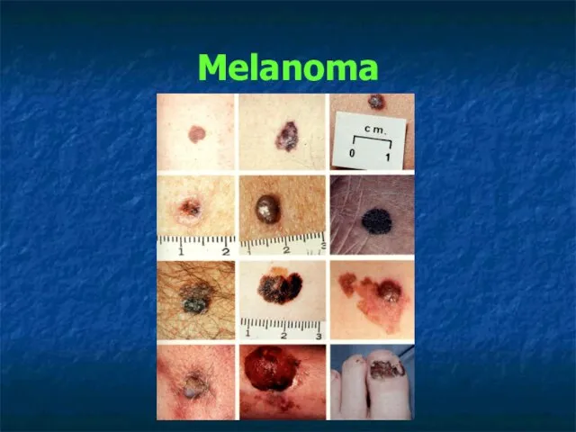 Melanoma