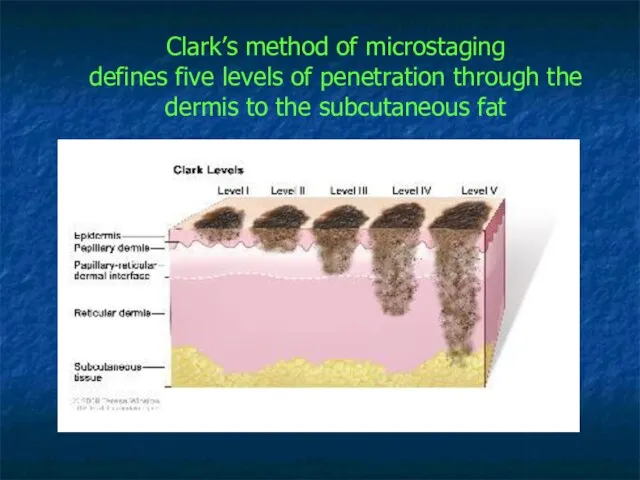 Clark’s method of microstaging defines five levels of penetration through the dermis to the subcutaneous fat