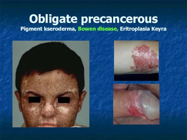 Obligate precancerous Pigment kseroderma, Bowen disease, Eritroplasia Keyra