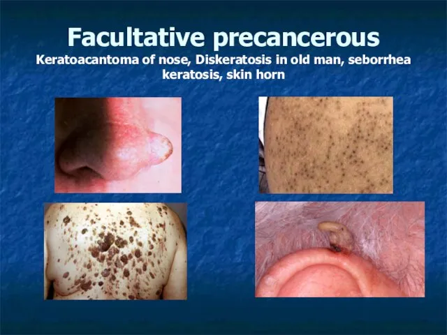 Facultative precancerous Keratoacantoma of nose, Diskeratosis in old man, seborrhea keratosis, skin horn