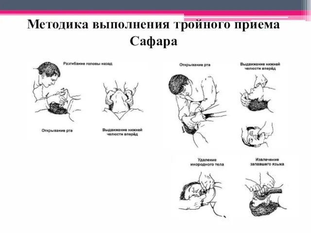 Методика выполнения тройного приема Сафара