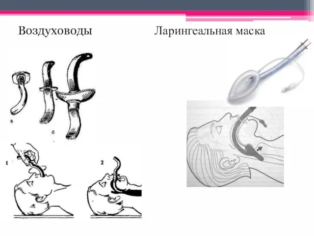 Воздуховоды Ларингеальная маска