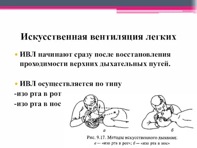 Искусственная вентиляция легких ИВЛ начинают сразу после восстановления проходимости верхних дыхательных